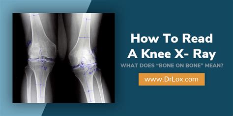 Dennis M Lox Md Explains How To Read A Bone On Bone Knee X Ray