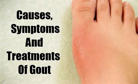 Causes Symptoms And Treatments Of Gout Health Care A To Z