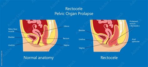 Pelvic Floor Prolapse Type Uterine Uterus Biofeedback Pelvic Floor Treatment Stage Degree Kegel