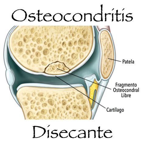 Osteocondritis Disecante Dr Edmundo Ford