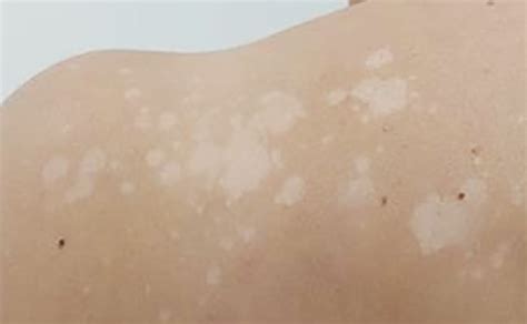 Do You Have White Patches On Your Skin Well It Might Be Pityriasis