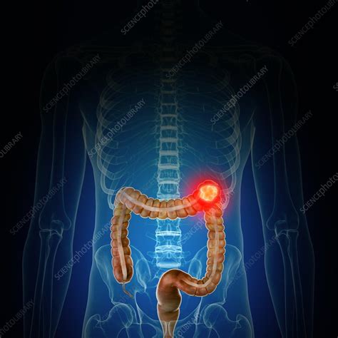 Illustration Of Colon Cancer Stock Image F Science Photo Library