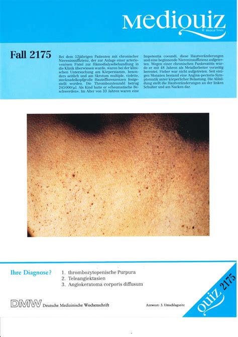 Pdf Angiokeratoma Corporis Diffusum Mediquiz Fall 2175 German