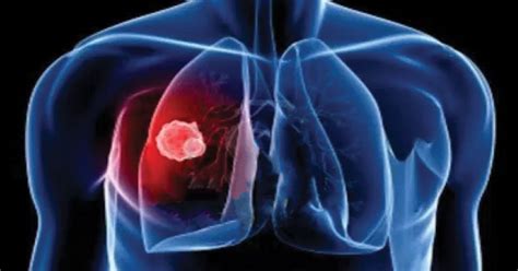 The main symptoms of mesothelioma of the lungs are shortness of breath and chest pain. 6 Early Signs and Symptoms of Mesothelioma - Marham