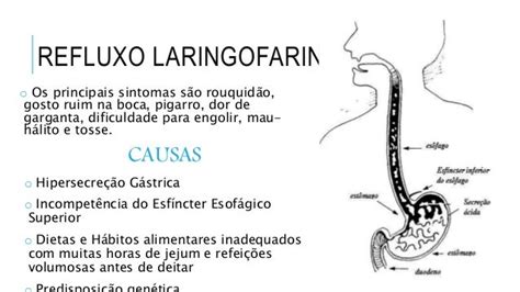 Refluxo Laringofaríngeo