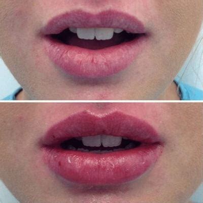 Each is a clear gel formulation of hyaluronic acid that is specifically designed to act like your body's own naturally produced hyaluronic acid. Lip Filler - The Cosmetic Clinic