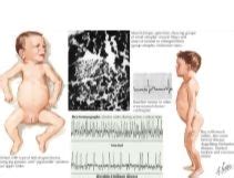 Werdnig-Hoffmann Disease