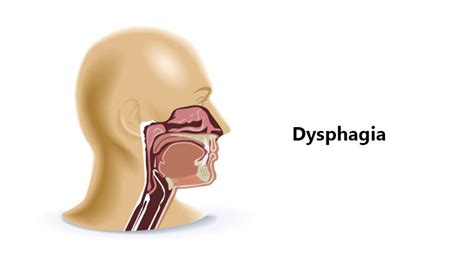 Oesophagus Causes Of Dysphagia Dr Meenesh Juveekar Ent Specialist