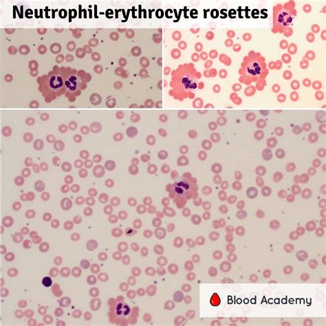 Leukocyte Erythrocyte Rosettes Blood Academy
