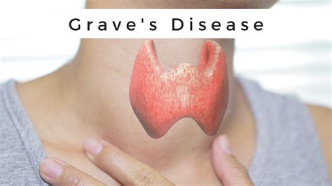 Neonatal Graves Disease