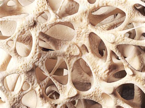 Sobre A Osteoporose Assinale A Alternativa Falsa