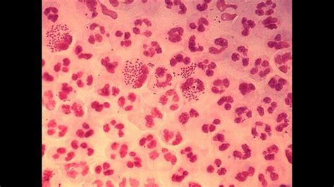 Gonorrhea May Soon Become Resistant To Antibiotics Cdc Says