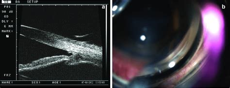 17 Traumatic Angle Recession On Ubm A And Gonioscope B