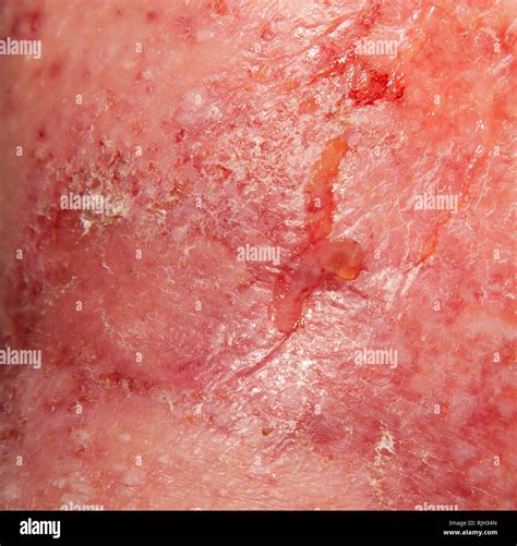 Acute Neurodermatitis Respectively Atopic Eczema Stock Photo Alamy