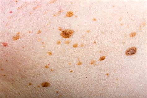 Seborrhoeic Keratosis Apax Medical And Aesthetics Clinic Singapore