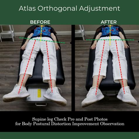 Pin On Before And After Chiropractic Adjustments
