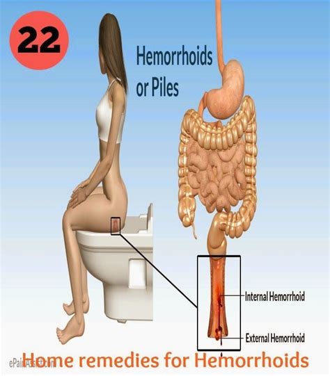 Symptoms of prolapsed internal hemorrhoids. 22 Home Remedies for Hemorrhoids | Home remedies for ...