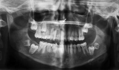Opg Depicting Impacted Teeth Hypoplastic Mandible And Root Resorption