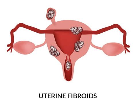 Noticing A Stomach Bulge You May Have Fibroids