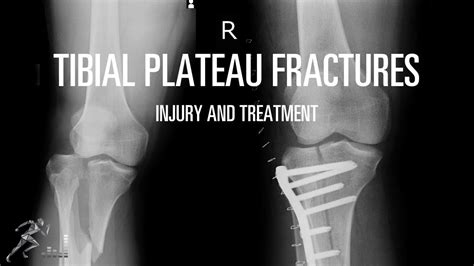 Posterior Tibial Plateau Fracture Radiology