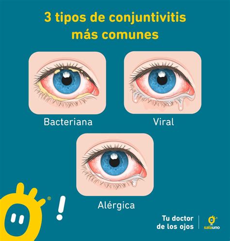 Conjuntivitis Síntomas Y Tratamiento Salauno