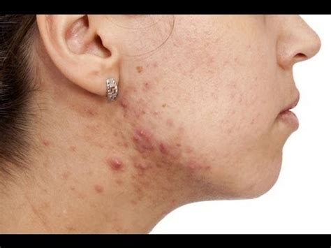 How to Treat Adult Acne [DermTV.com Epi #494] 
