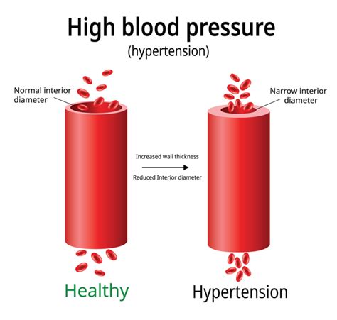High Blood Pressure Hypertension Symptoms And Treatment Dr Raghu