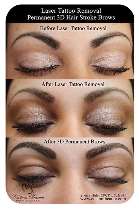Maybe you would like to learn more about one of these? Laser Tattoo Removal in Amherst, Buffalo and Western NY