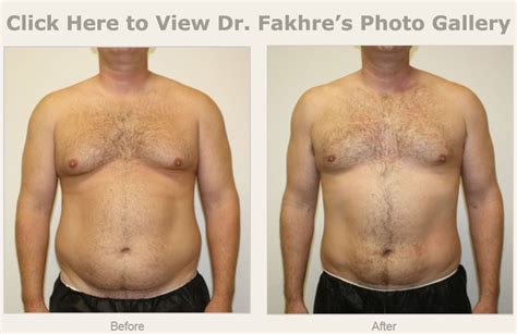 Liposuction Before And After Men
