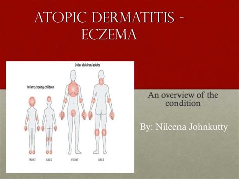 Ppt Atopic Dermatitis Eczema Powerpoint Presentation Id2351905