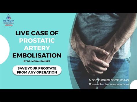 Live Case Of Prostatic Artery Embolization Bankers Vascular Centre