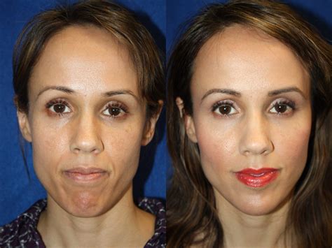 Dermal Fillers Before And After Pictures Boston Ma