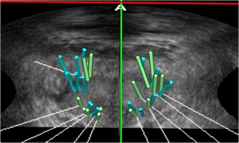 Utility Of Ultrasound In The Diagnosis Treatment And Follow Up Of