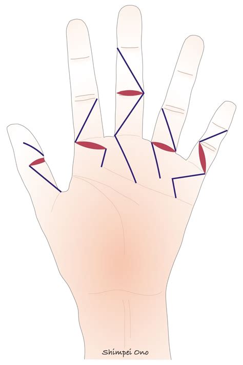 【診療tips】手指手術の切開法：bruners Incision、midlateral Incision