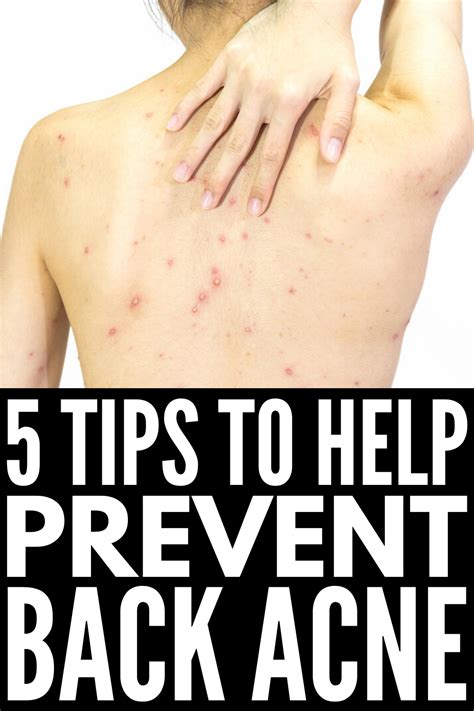 How To Get Rid Of Back Acne If You Want To Know What Causes Back Acne
