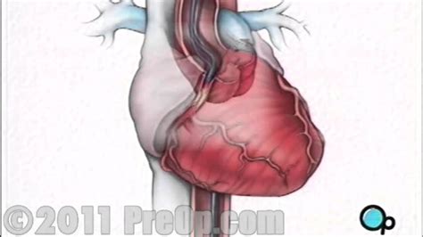 Heart Stent Implantation Coronary Angioplasty Preop