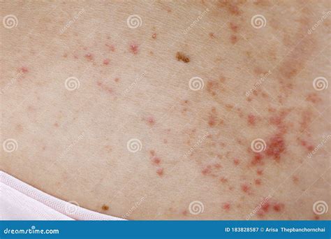 Skin Disease Prickly Heat Rash Or Miliaria On Back Skin Of Asian Woman