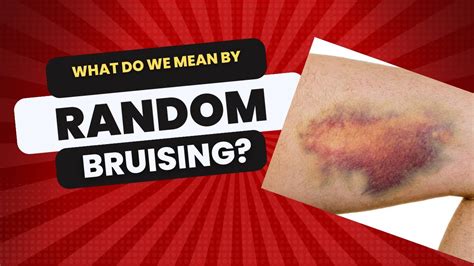 What Do We Mean By Random Bruising Youtube