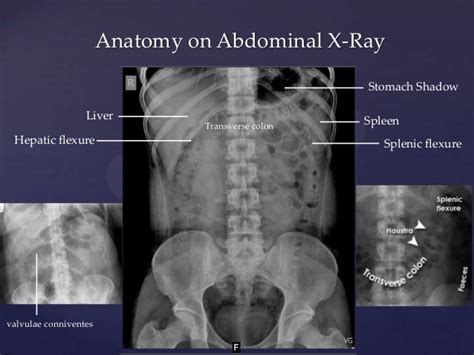 X Ray Normal Abdomen