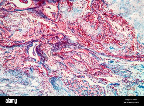 Mixed Tumor Of The Parotid Gland Diseased Tissue 100x Stock Photo Alamy