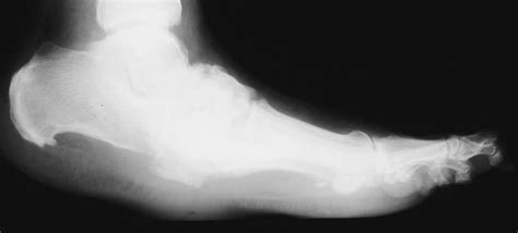 It can be difficult to deal with, but having treatment as early as possible can reduce your risk of further problems, like developing a foot ulcer or needing an amputation. Everything you need to know about Charcot Foot but were ...