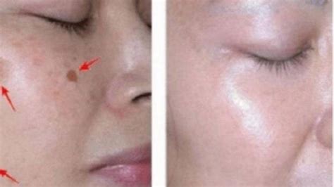 Lidah buaya yang digunakan dalam bentuk losion, krim, atau gel, bisa menyebabkan iritasi kulit pada beberapa orang. Cara Menghilangkan Flek Hitam Secara Alami Dengan Lidah Buaya