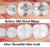 Photos of Dental Silver Fillings
