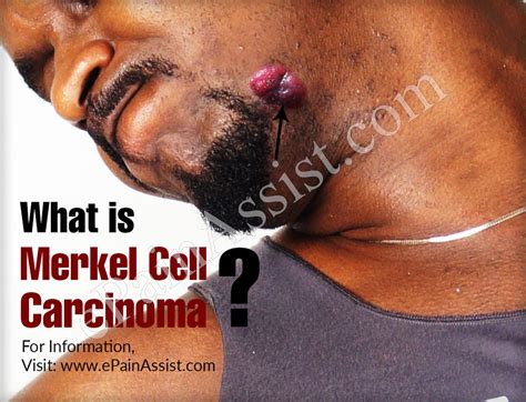 The following tests are used to identify merkel cell carcinoma, and to determine its stage (how far the disease has. What is Merkel Cell Carcinoma (MCC)|Causes|Symptoms ...