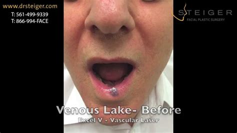 Laser Of A Venous Lake On The Lip Excel V Youtube