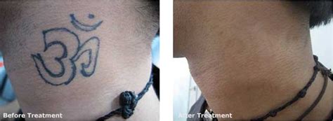 It also helps to apply a thin coating of antibiotic ointment or. How can I speed up laser tattoo removal? - Blog - Aura ...