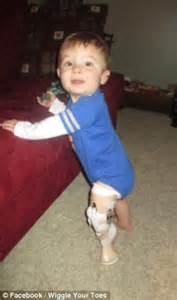 Vincent Lynick Born Without A Bone In His Lower Leg Learns To Walk