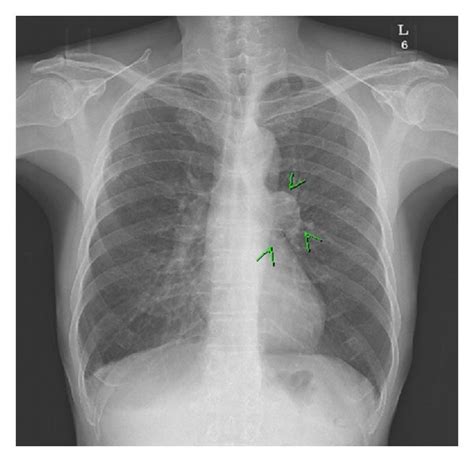 A Chest X Ray In The Left Hilar Lung Tumors Are Found B Chest Ct