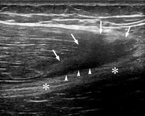 Imaging Of Muscle Injuries In Sports Medicine Sports Imaging Series