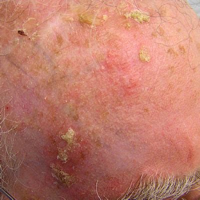 Actinic Keratosis Image